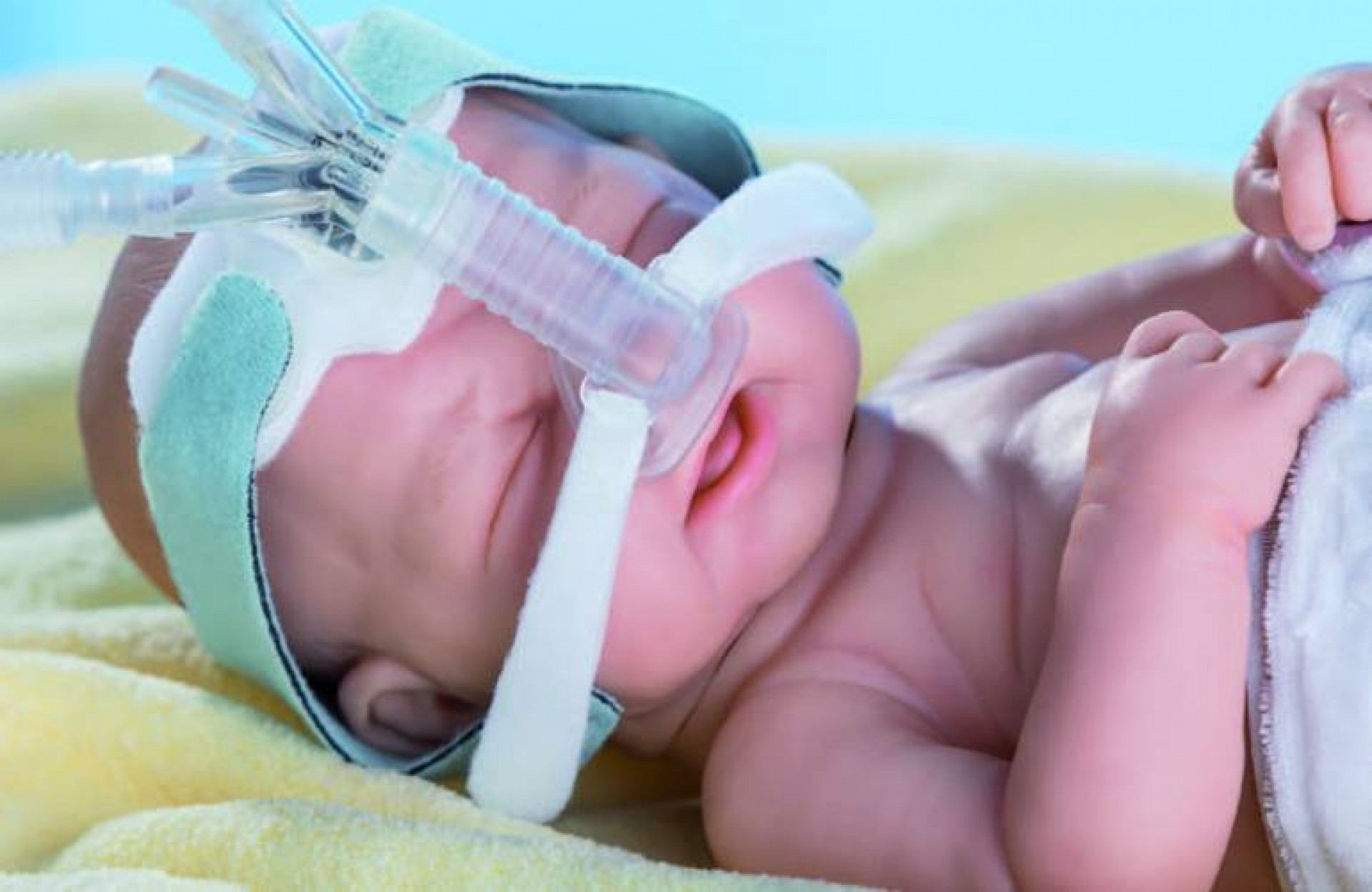 Вентиляция легких новорожденному